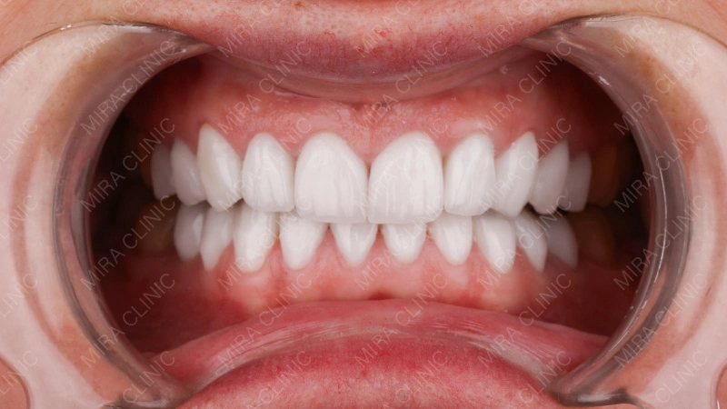 Hollywood smile Experience Inside Mira Clinic